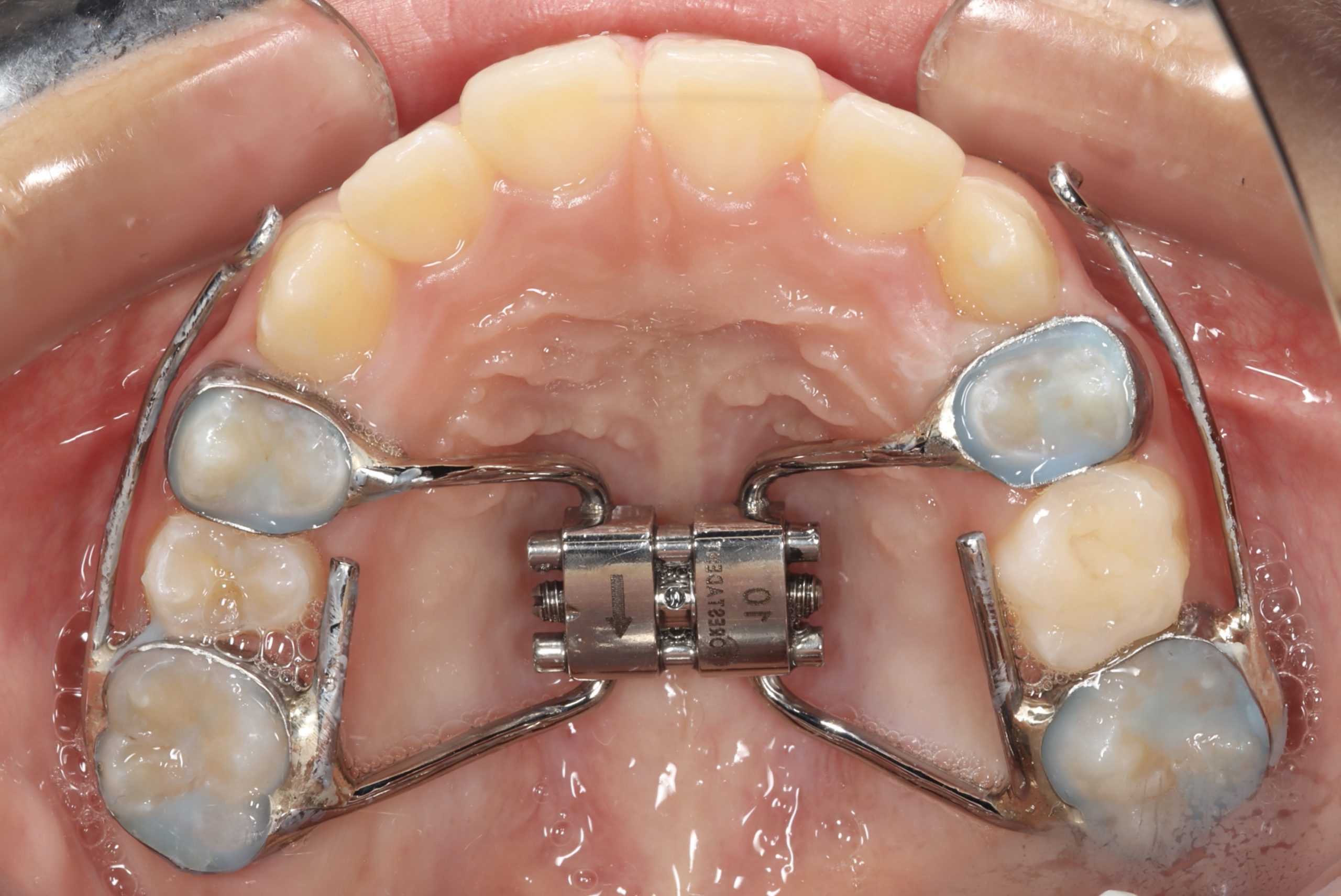 生理的機能咬合を考慮した矯正治療 | ブログ | 羽村市 うすい歯科