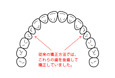 矯正方法 画像