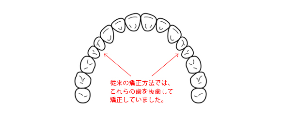 矯正方法 画像