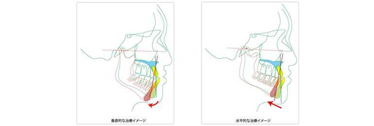 矯正治療 画像