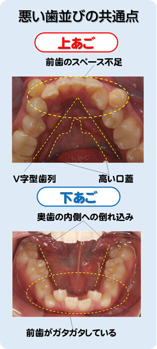悪い歯並びの共通点