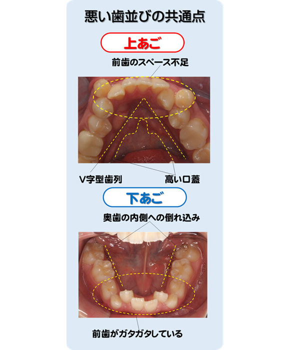 悪い歯並びの共通点
