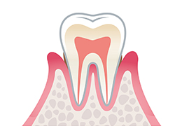 歯肉炎 画像