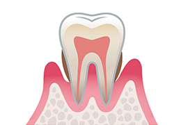 軽度歯周炎 画像