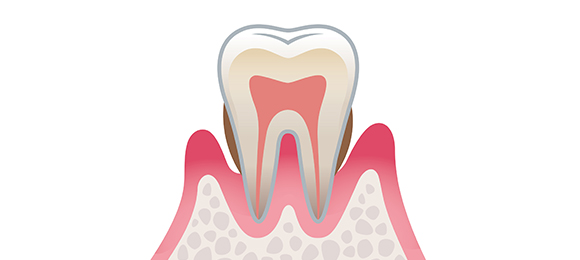 軽度歯周炎 画像