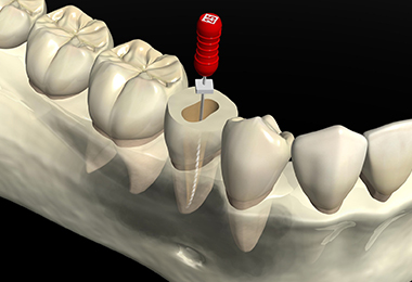 精密根管治療 イメージ画像