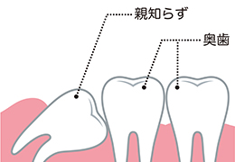 親知らずとは 画像