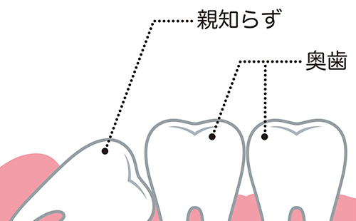 親知らずとは 画像